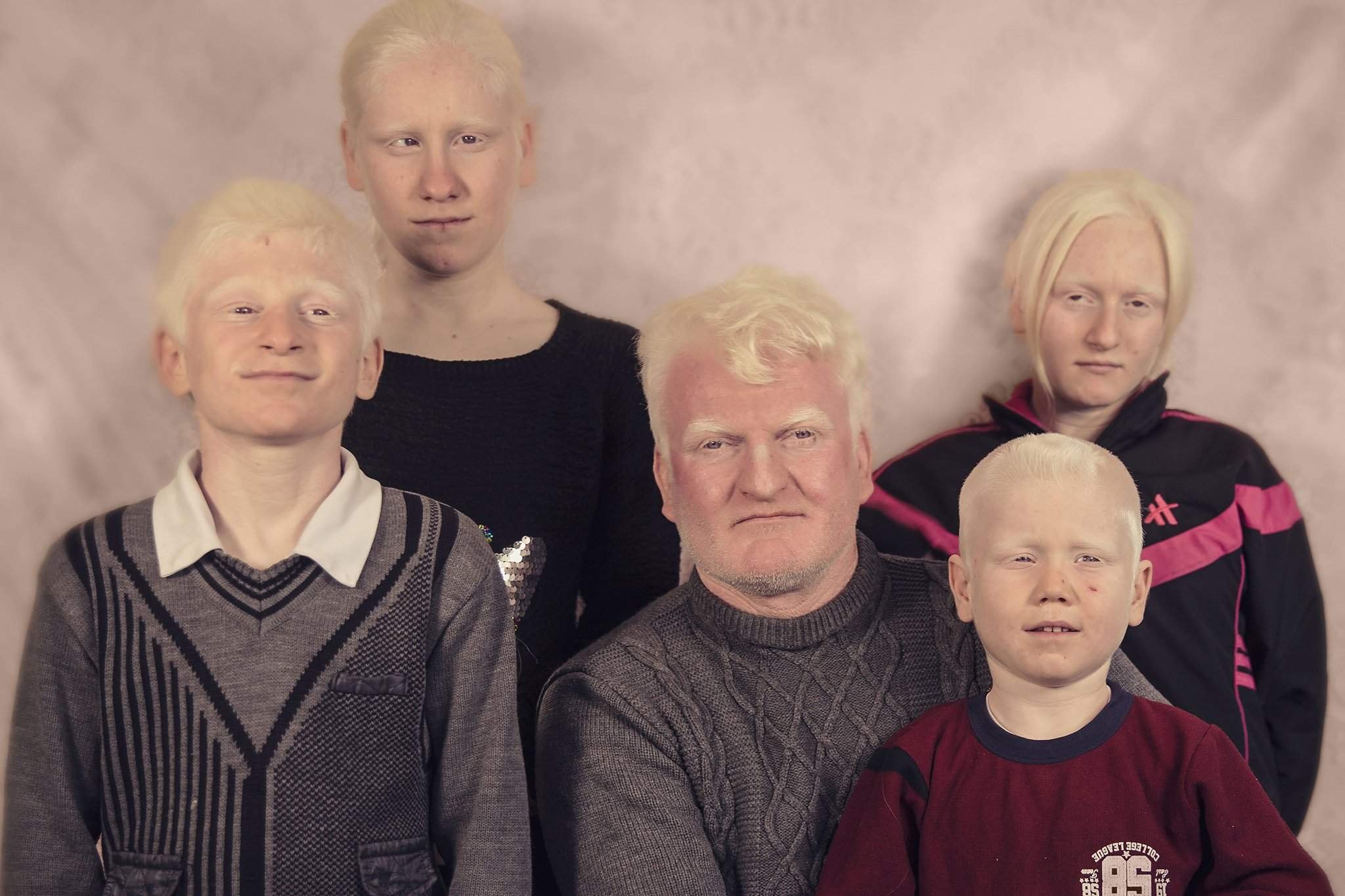 Как люди рождаются альбиносами. Альбинизм 1в. Шимон альбинос. Альбинизм хромосомная мутация. Альбинос европеец.